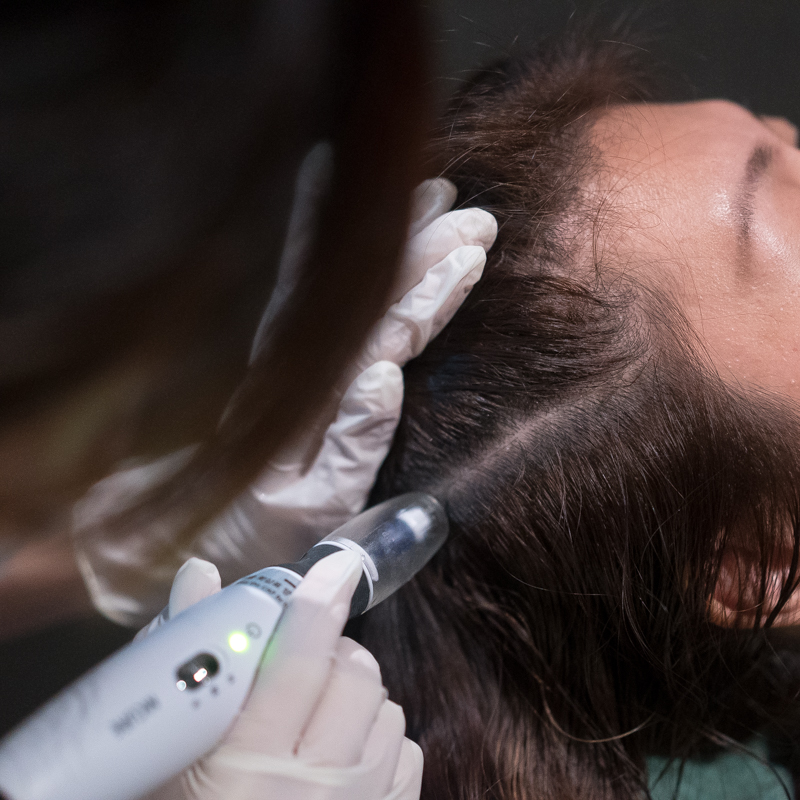 ¿CÓMO FUNCIONA LA MESOTERAPIA EN LA PÉRDIDA DEL PELO_